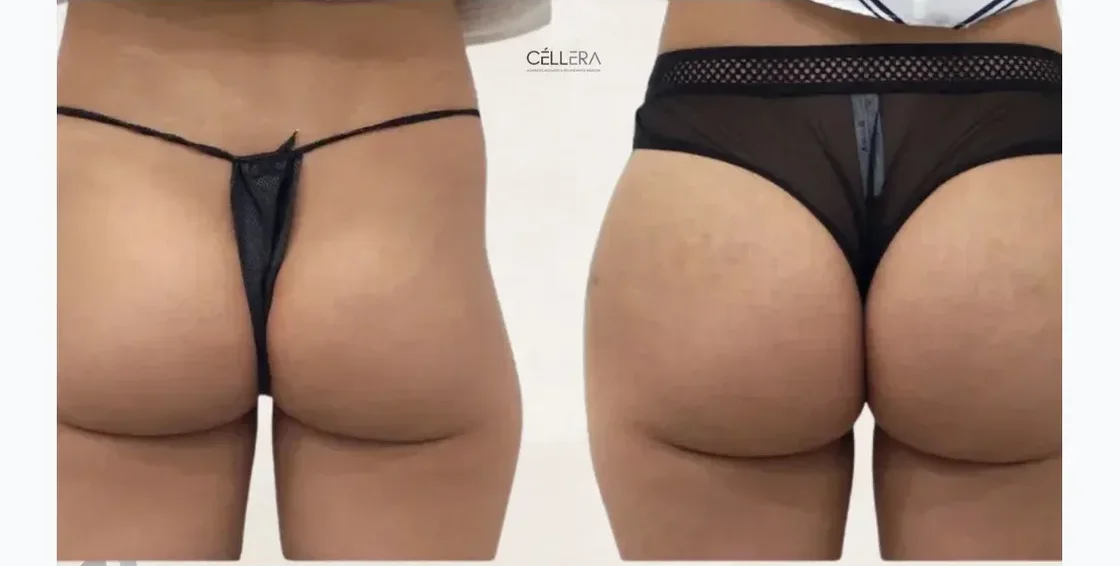 Butt Lift